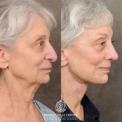 Beverly Hills Center Female Patient Before and After AuraLyft, Brow Lift, Upper & Lower Blepharoplasty, CUPID LIFT® Lip Lift, Rhinoplasty