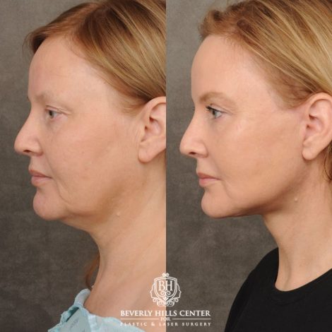Beverly Hills Center Female Patient Before and After Comprehensive AuraLyft, CUPID LIFT®, Rhinoplasty, Brow Lift, Upper Blepharoplasty and Buccal Fat transfer