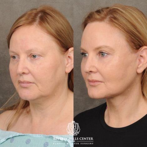 Beverly Hills Center Female Patient Before and After Comprehensive AuraLyft, CUPID LIFT®, Rhinoplasty, Brow Lift, Upper Blepharoplasty and Buccal Fat transfer