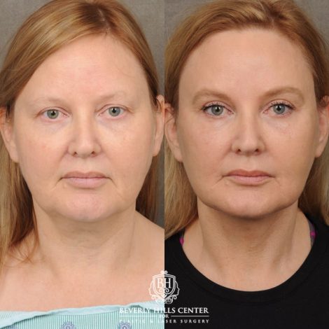 Beverly Hills Center Female Patient Before and After Comprehensive AuraLyft, CUPID LIFT®, Rhinoplasty, Brow Lift, Upper Blepharoplasty and Buccal Fat transfer