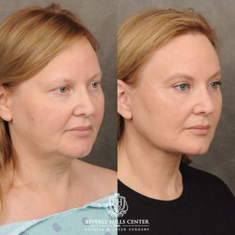 Beverly Hills Center Female Patient Before and After Comprehensive AuraLyft, CUPID LIFT®, Rhinoplasty, Brow Lift, Upper Blepharoplasty and Buccal Fat transfer