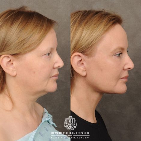 Beverly Hills Center Female Patient Before and After Comprehensive AuraLyft, CUPID LIFT®, Rhinoplasty, Brow Lift, Upper Blepharoplasty and Buccal Fat transfer