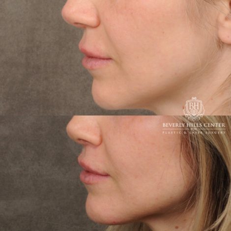 Beverly Hills Center Female Patient Before and After CUPID LIFT® Lip Lift