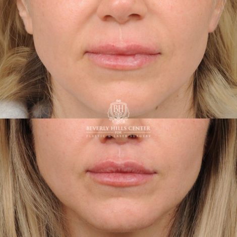 Beverly Hills Center Female Patient Before and After CUPID LIFT® Lip Lift