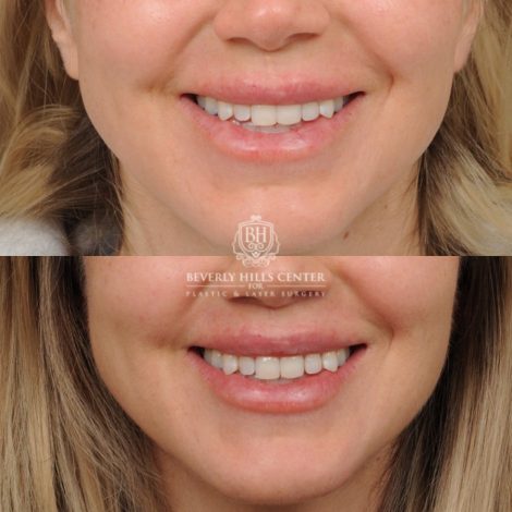Beverly Hills Center Female Patient Before and After CUPID LIFT® Lip Lift