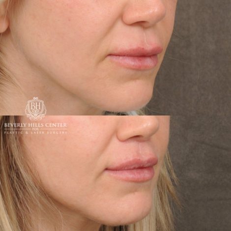Beverly Hills Center Female Patient Before and After CUPID LIFT® Lip Lift