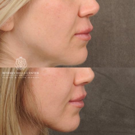 Beverly Hills Center Female Patient Before and After CUPID LIFT® Lip Lift