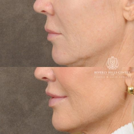 Beverly Hills Center Female Patient Before and After Brow Lift, CUPID LIFT® Lip Lift, with corners, Co2 around the mouth