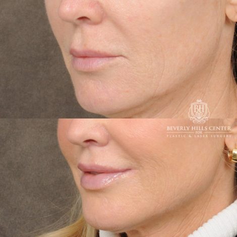Beverly Hills Center Female Patient Before and After Brow Lift, CUPID LIFT® Lip Lift, with corners, Co2 around the mouth