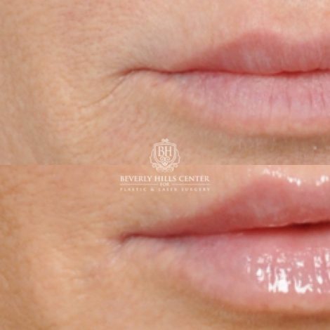 Beverly Hills Center Female Patient Before and After Brow Lift, CUPID LIFT® Lip Lift, with corners, Co2 around the mouth