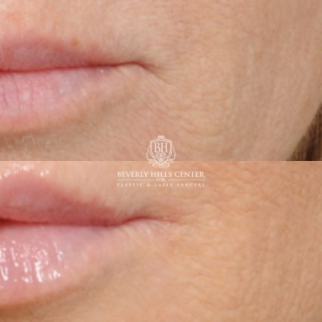 Beverly Hills Center Female Patient Before and After Brow Lift, CUPID LIFT® Lip Lift, with corners, Co2 around the mouth