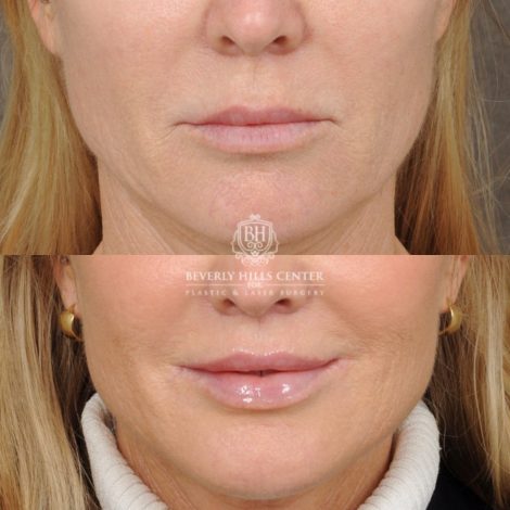Beverly Hills Center Female Patient Before and After Brow Lift, CUPID LIFT® Lip Lift, with corners, Co2 around the mouth