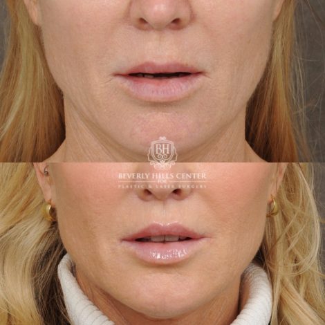 Beverly Hills Center Female Patient Before and After Brow Lift, CUPID LIFT® Lip Lift, with corners, Co2 around the mouth