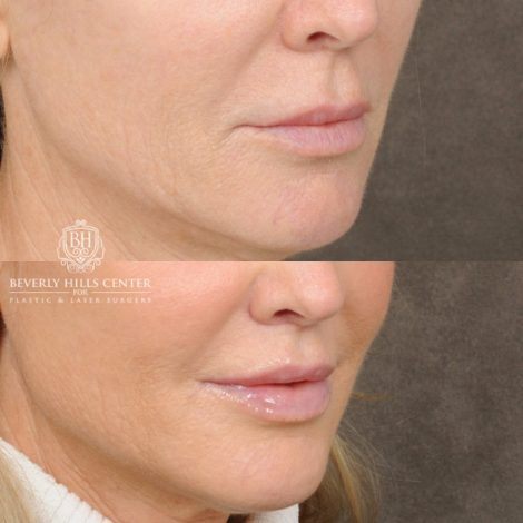 Beverly Hills Center Female Patient Before and After Brow Lift, CUPID LIFT® Lip Lift, with corners, Co2 around the mouth