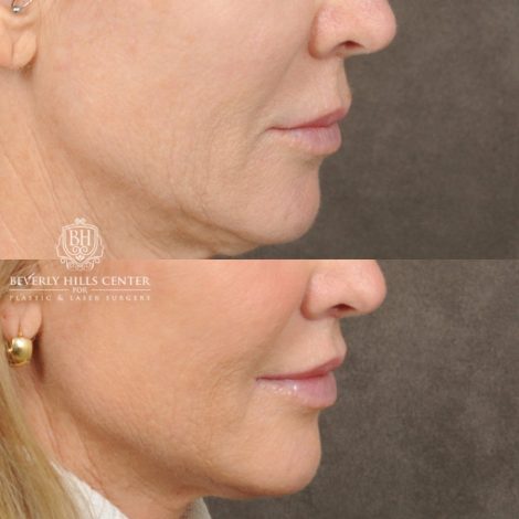 Beverly Hills Center Female Patient Before and After Brow Lift, CUPID LIFT® Lip Lift, with corners, Co2 around the mouth