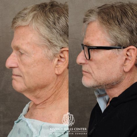 male patient before and after AuraLyft, Brow Lift procedures