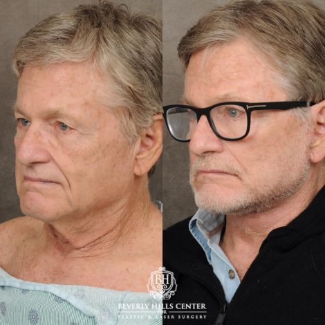 male patient before and after AuraLyft, Brow Lift procedures