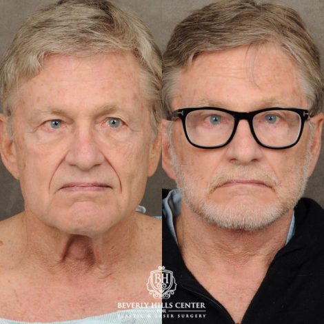 male patient before and after AuraLyft, Brow Lift procedures