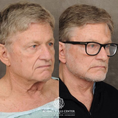 male patient before and after AuraLyft, Brow Lift procedures