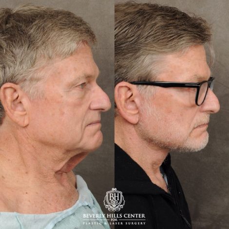 male patient before and after AuraLyft, Brow Lift procedures