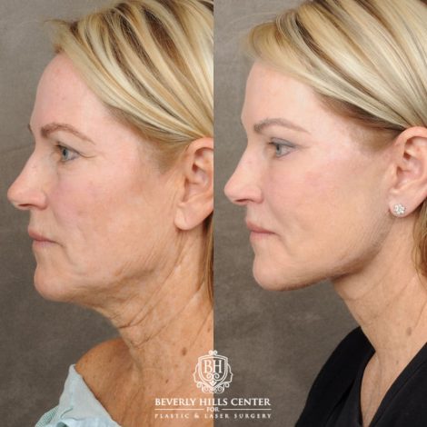female patient before and after AuraLyft, Brow Lift, Upper & Lower Blepharoplasty, CUPID LIFT® Lip Lift procedures