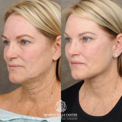 female patient before and after AuraLyft, Brow Lift, Upper & Lower Blepharoplasty, CUPID LIFT® Lip Lift procedures