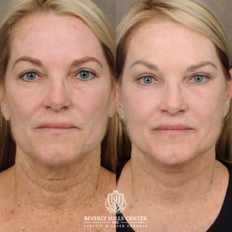 female patient before and after AuraLyft, Brow Lift, Upper & Lower Blepharoplasty, CUPID LIFT® Lip Lift procedures