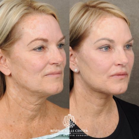 female patient before and after AuraLyft, Brow Lift, Upper & Lower Blepharoplasty, CUPID LIFT® Lip Lift procedures