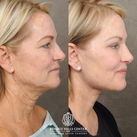 female patient before and after AuraLyft, Brow Lift, Upper & Lower Blepharoplasty, CUPID LIFT® Lip Lift procedures