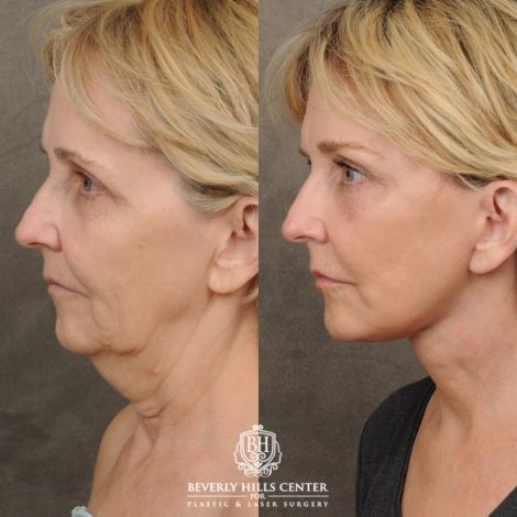 female patient before and after AuraLyft, CUPID LIFT® Corner Lift, Brow Lift, Upper Blepharoplasty procedure