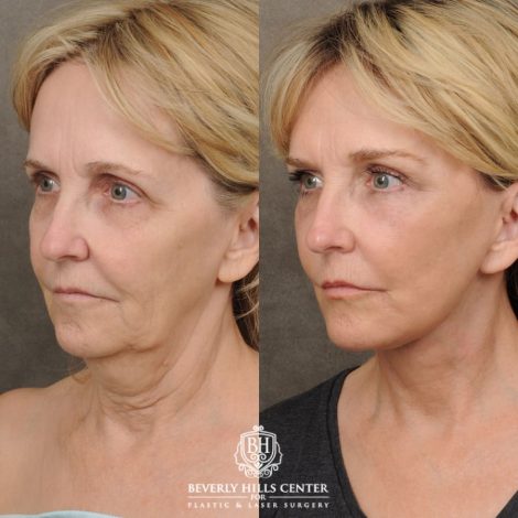 female patient before and after AuraLyft, CUPID LIFT® Corner Lift, Brow Lift, Upper Blepharoplasty procedure