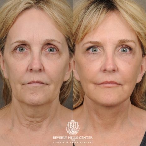 female patient before and after AuraLyft, CUPID LIFT® Corner Lift, Brow Lift, Upper Blepharoplasty procedure