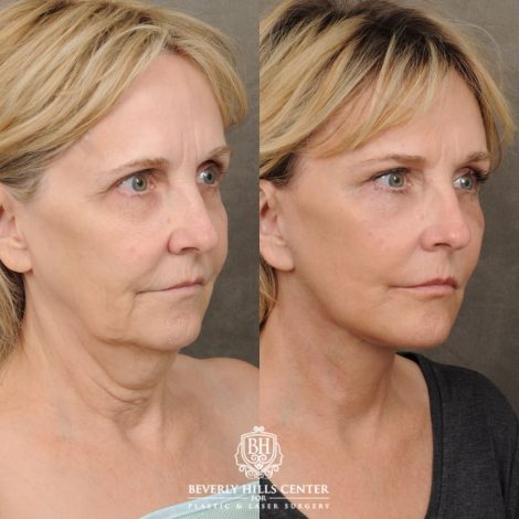 female patient before and after AuraLyft, CUPID LIFT® Corner Lift, Brow Lift, Upper Blepharoplasty procedure