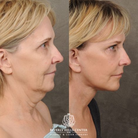 female patient before and after AuraLyft, CUPID LIFT® Corner Lift, Brow Lift, Upper Blepharoplasty procedure