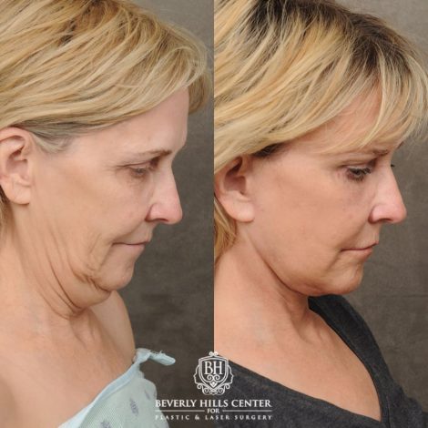 female patient before and after AuraLyft, CUPID LIFT® Corner Lift, Brow Lift, Upper Blepharoplasty procedure