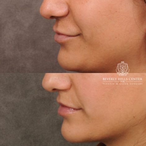 female patient before and after CUPID LIFT® with Corners procedure