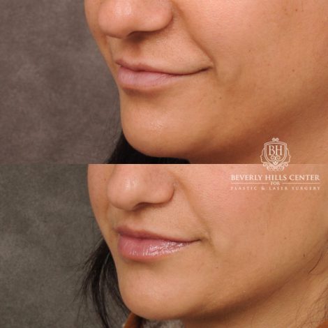 female patient before and after CUPID LIFT® with Corners procedure