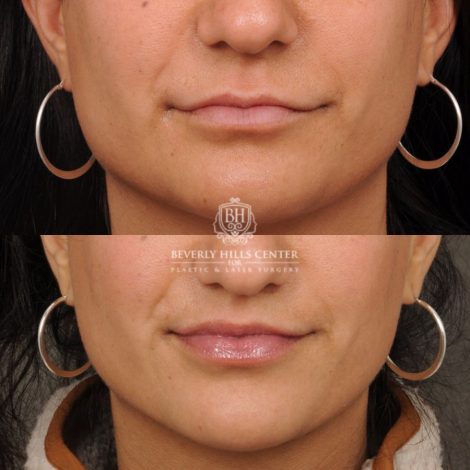 female patient before and after CUPID LIFT® with Corners procedure