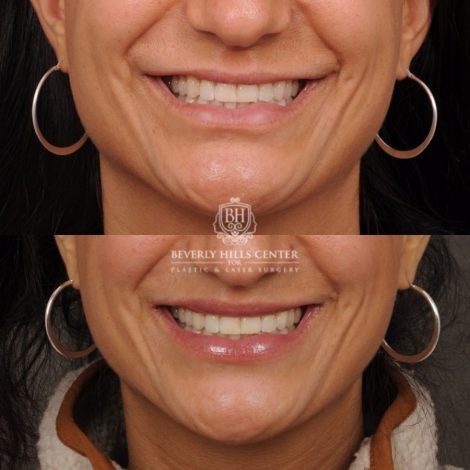female patient before and after CUPID LIFT® with Corners procedure