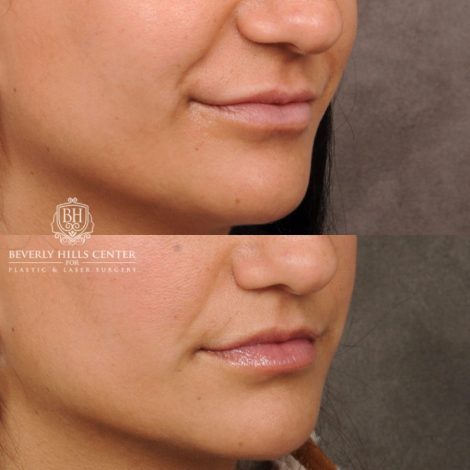 female patient before and after CUPID LIFT® with Corners procedure