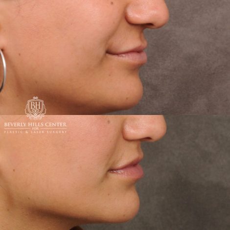 female patient before and after CUPID LIFT® with Corners procedure