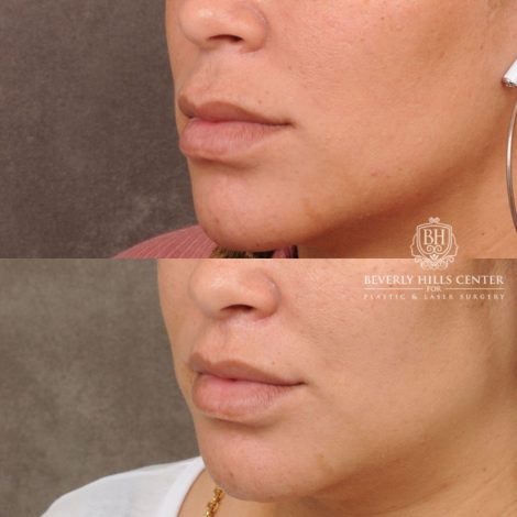 female patient before and after CUPID LIFT® Corner Lift procedure