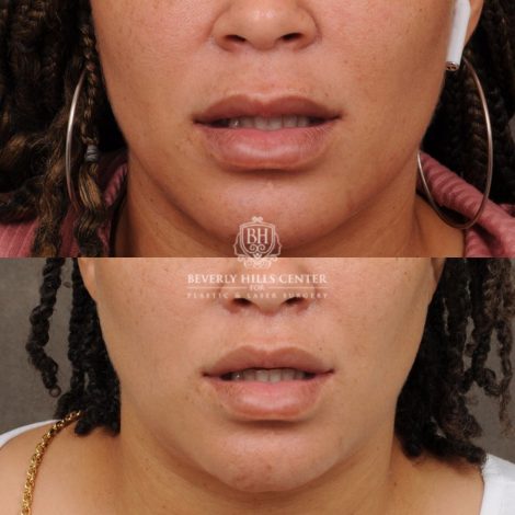 female patient before and after CUPID LIFT® Corner Lift procedure