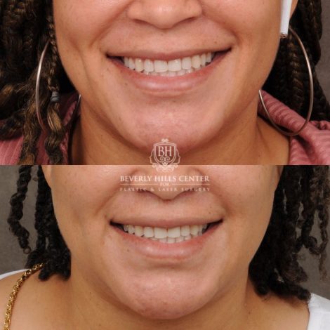 female patient before and after CUPID LIFT® Corner Lift procedure