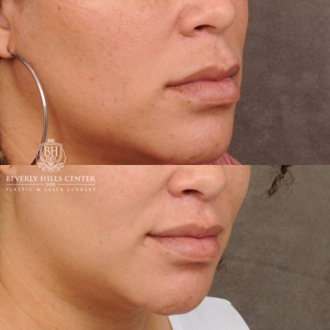 female patient before and after CUPID LIFT® Corner Lift procedure