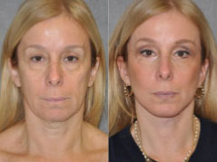 before and after photos