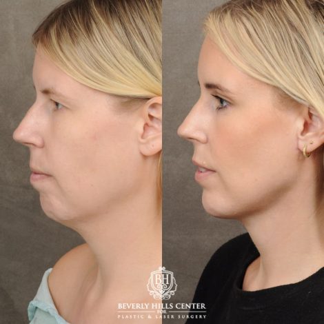 female patient before and after Brow Lift & Weekend Neclkift