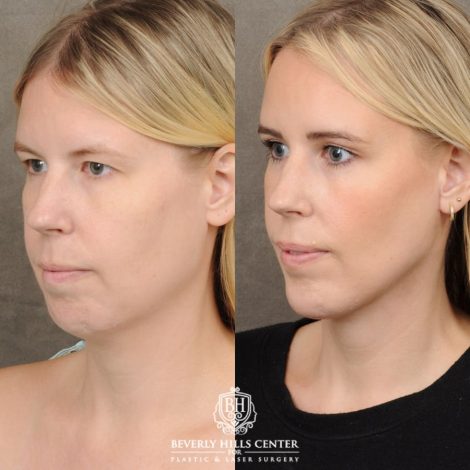 female patient before and after Brow Lift & Weekend Neclkift