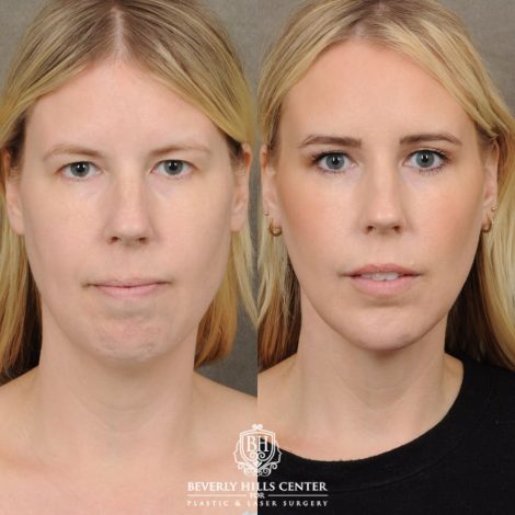 female patient before and after Brow Lift & Weekend Neclkift