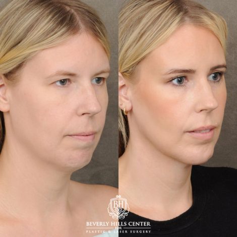 female patient before and after Brow Lift & Weekend Neclkift